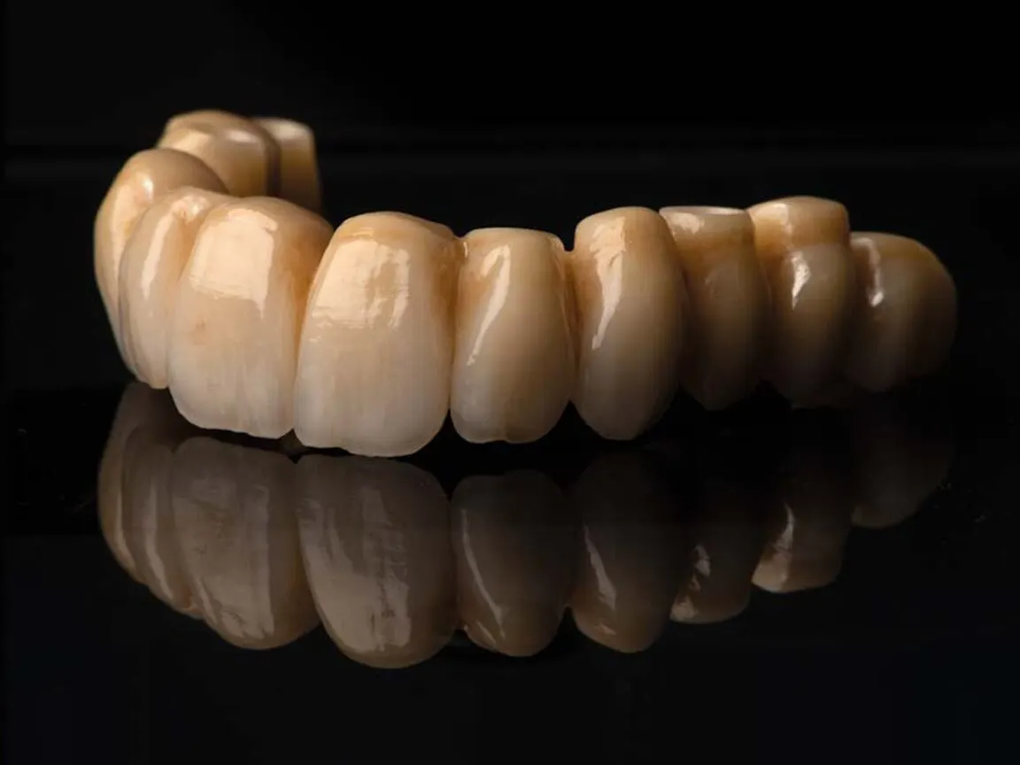 A full-arch bridge on a titanium framework, with the four screw channels that fix it to the implants visible underneath.