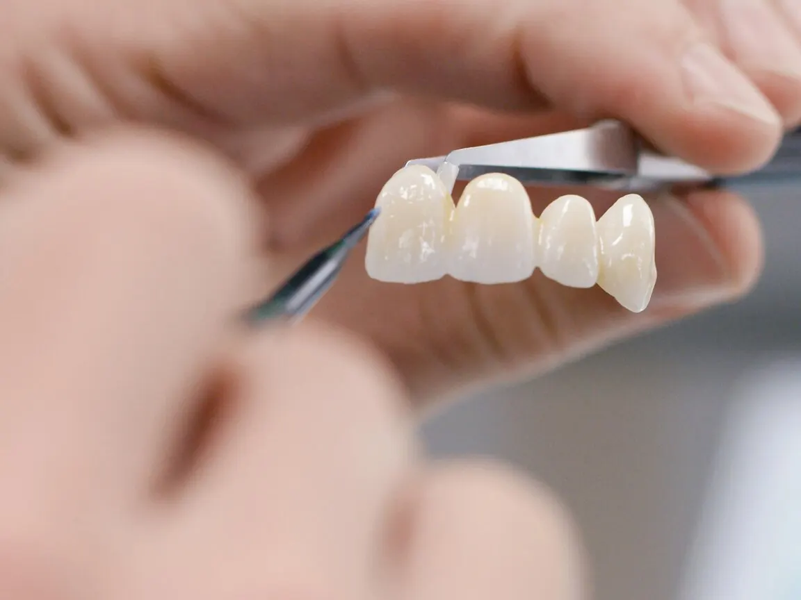 Three lithium-disilicate veneers — wafer-thin translucent porcelain shells, light passing through their edges.