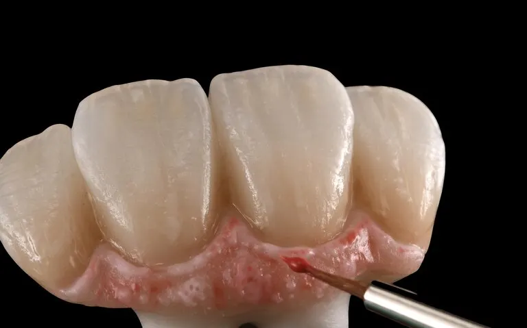 A single zirconia crown: a tooth-shaped ceramic cap, hollow underneath where it fits over the prepared tooth.